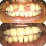 Restoration_of_fractured_and_extracted_tooth_after_RTA